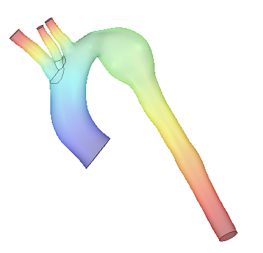 3D anurysm aorta