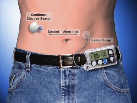 21235_large_Insulin-Pump